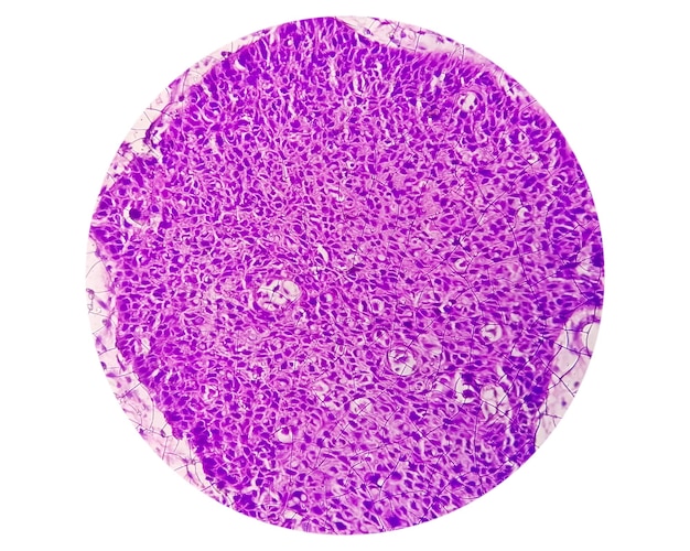 Microfoto van tongplaveiselcelcarcinoom graad II. Oraal invasief SCC.