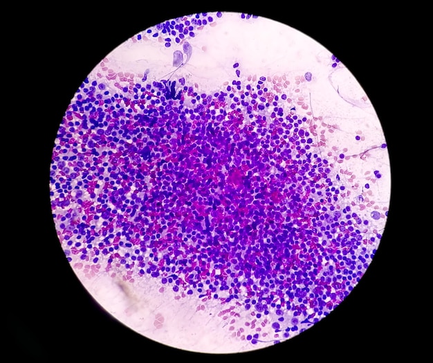 Microscopic image of Chronic non specific lymphadenitis or CNSLA