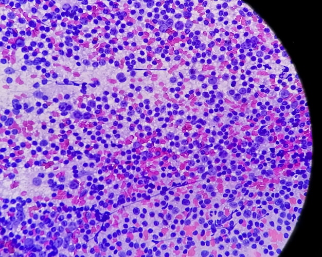 Photo microscopic image of chronic non specific lymphadenitis or cnsla