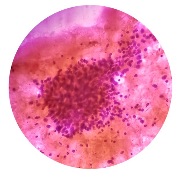 Microscopic image of clear cell carcinoma of kidney or renal cancer