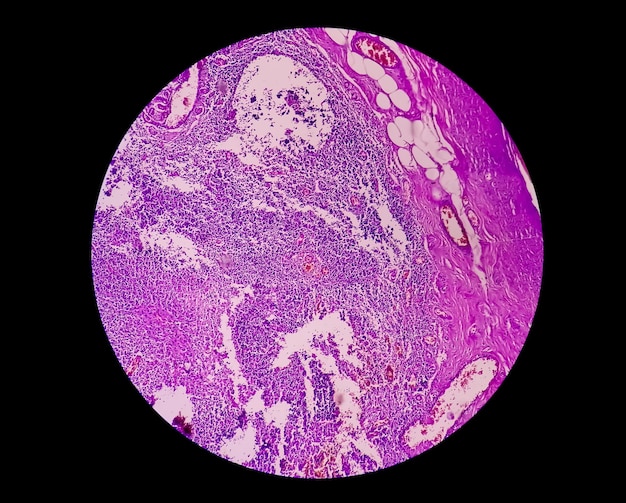 급성 충수염이 있는 어린이의 맹장 단면의 현미경 이미지