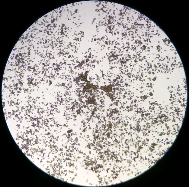 Microscopic image of Urinalysis. Abnormal urine exam. Uric acid crystals.