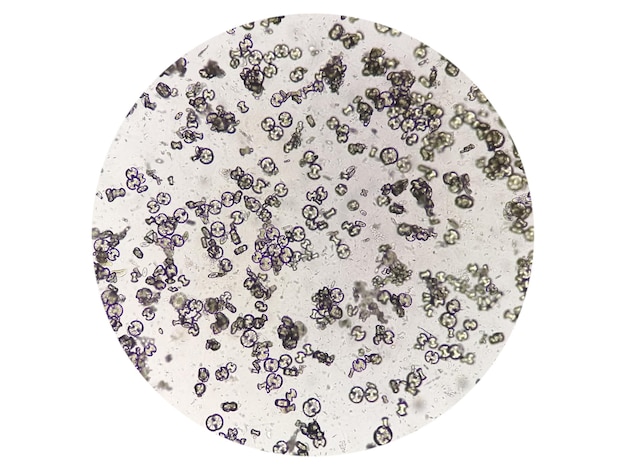 Microscopic Urinalysis showing calcium oxalate monohydrate, uric acid and triple phosphate crystal