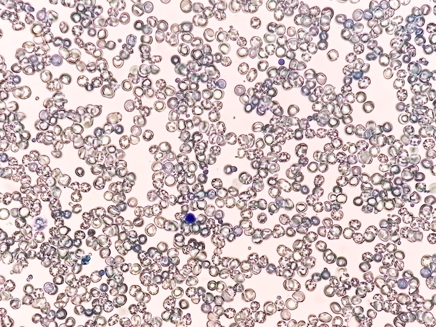 メチレンブルー染色による血液学部門の異常な網状赤血球数の顕微鏡写真