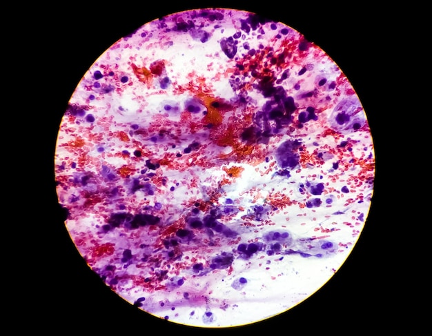 Microscopic view of Histology stained slide showing carcinoma