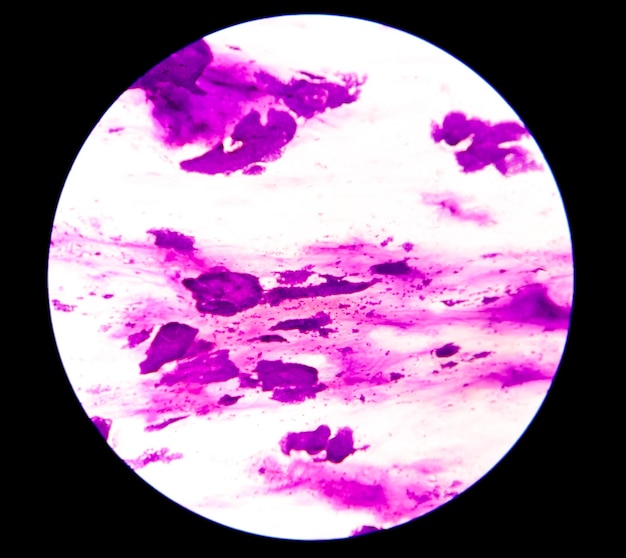 Photo microscopic view of metastatic squamous cell carcinoma atypical squamous epithelial cells fnac