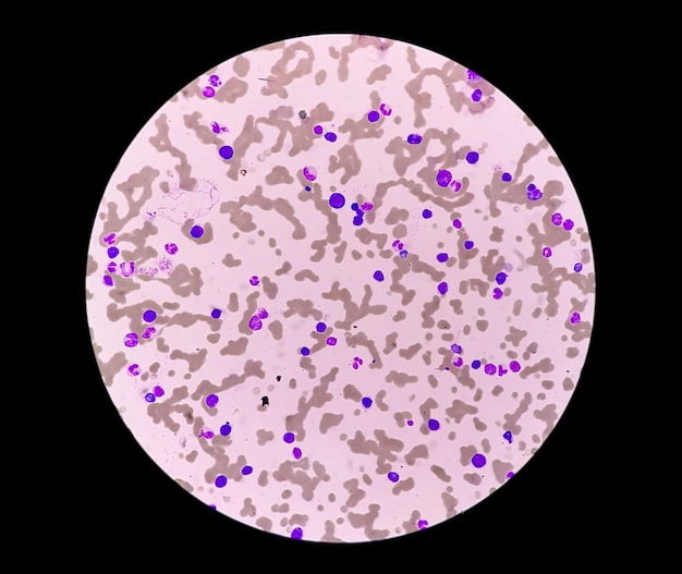 Microscopic view of Plasma cell leukemia or PCL