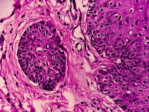 Microscopic view of skin cells infected with the HPV Virus called Common Wart or Verruca vulgaris