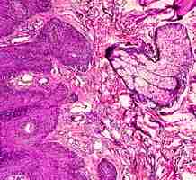 Photo microscopic view of skin cells infected with the hpv virus called common wart or verruca vulgaris