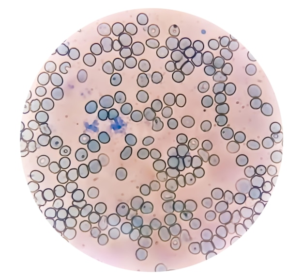 Foto microscopisch beeld van abnormaal aantal reticulocyten op de afdeling hematologie met methyleenblauwkleuring