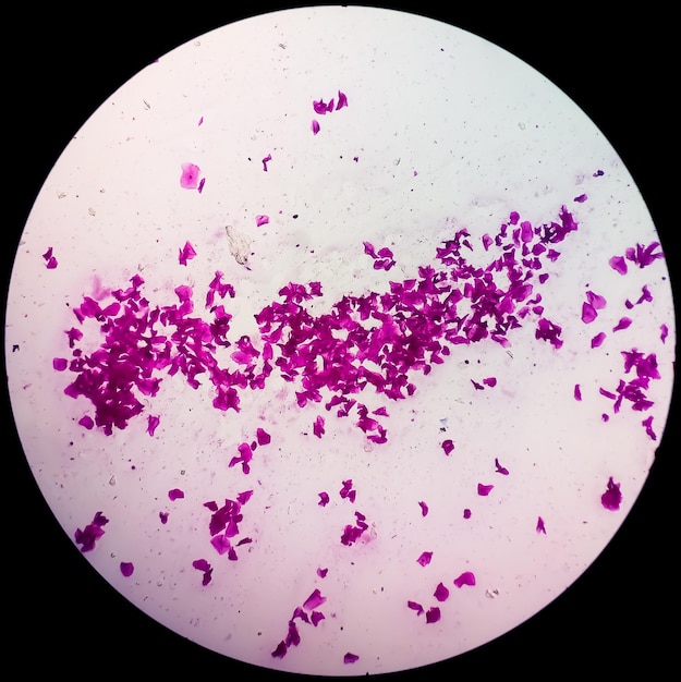 Microscopisch beeld van een hoog vaginaal uitstrijkje Gram-vlekuitstrijkje voor de diagnose van bacteriële vaginose