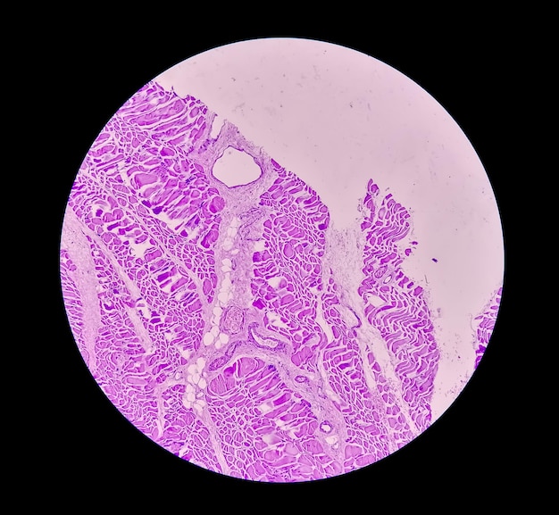 Microscopisch beeld van histologisch weefselonderzoek dat rabdomyoma aantoont