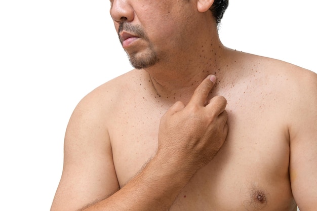 Middle age senior man point to skin tags or acrochordon on his neck isolated on white background