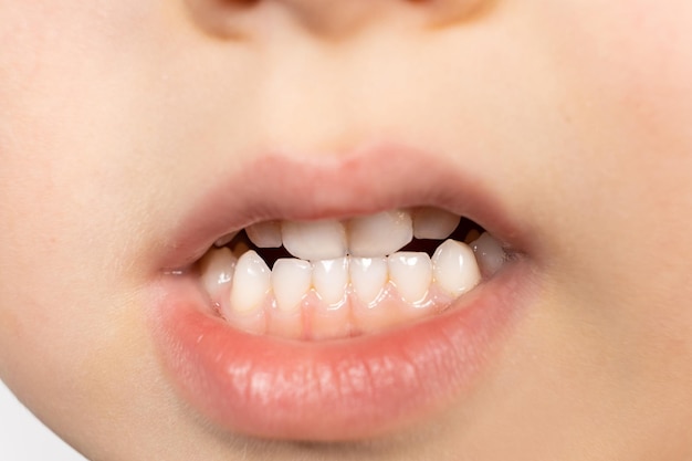 Milk teeth of a fiveyearold child bite plaque on the teeth hygiene and care