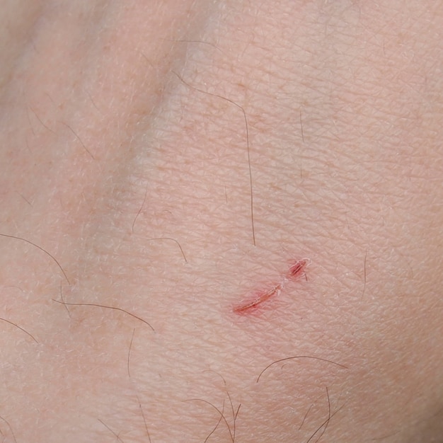 Minor hand scar