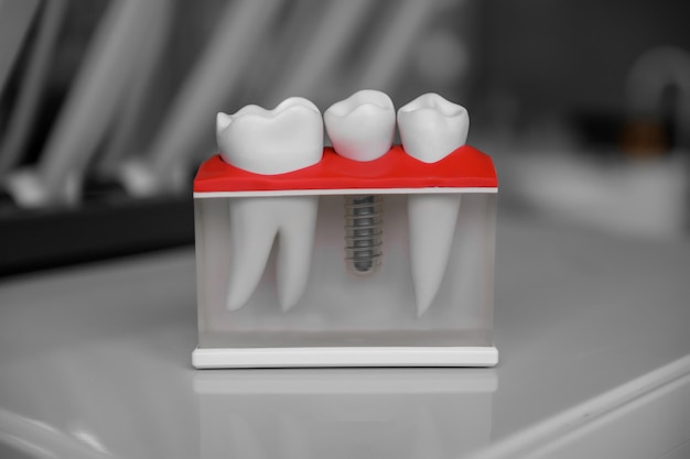 The model of the jaw and dental prosthesis