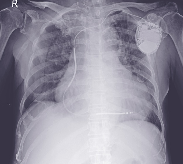 Moderate pulmonary congestion.with pacemaker in place.