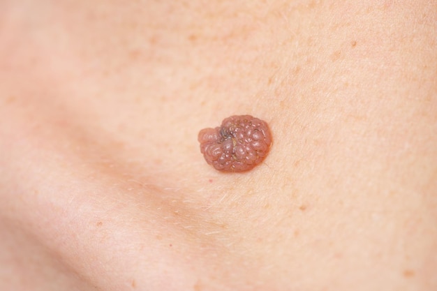 Mole birthmark nevus macro photo on human skin Close up