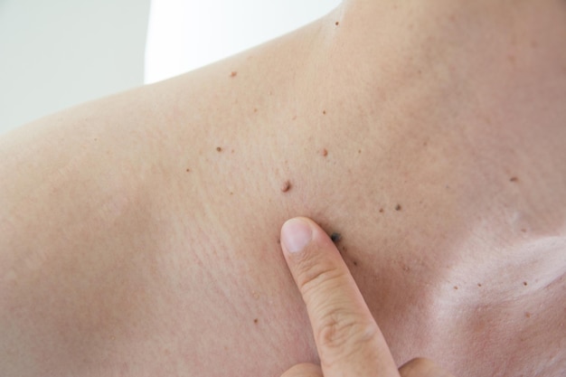 Mole or wart on the men skin