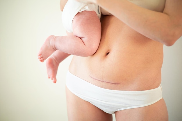 Mom's abdomen after cesarean section Scar seam A young mother holds the baby Real motherhood