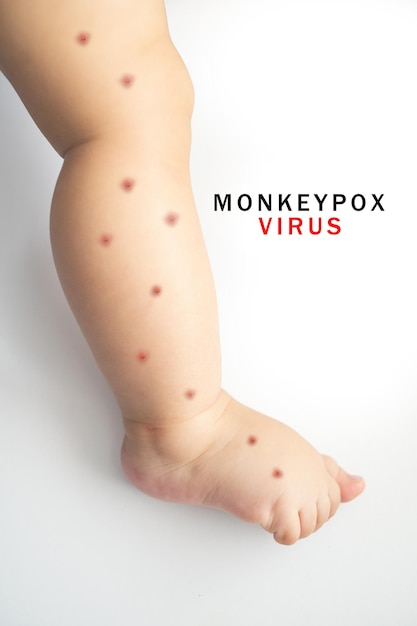 Monkey pox new disease. Baby with monkey pox. Painful rash, blisters of red spots on hand.