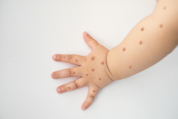 Monkey pox new disease. baby with monkey pox. painful rash,\
blisters of red spots on hand.