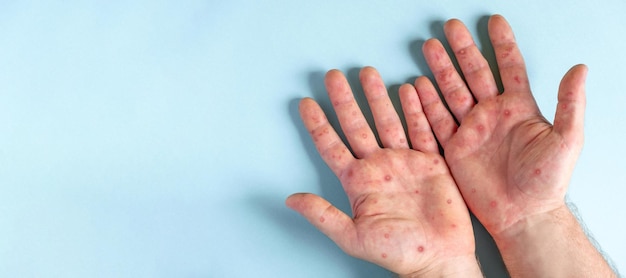 Monkeypox disease patient with monkey pox rash on hand close up\
rash human hands banner copy space