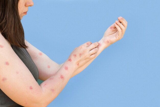 写真 サル痘病サル痘の患者が手に発疹発疹を閉じます人間の手バナーコピースペース