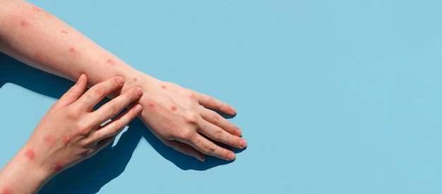 Monkeypox nieuwe ziekte gevaarlijk over de wereld Patiënt met Monkey Pox Pijnlijke uitslag rode vlekken blaren op de hand Close-up huiduitslag menselijke handen met gezondheidsprobleem Banner kopie ruimte
