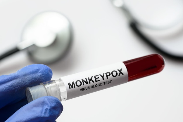 의사의 손에 있는 Monkeypox 테스트 튜브