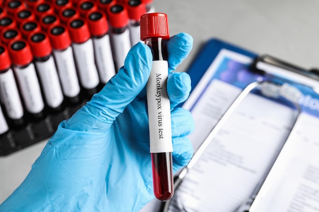 Monkeypox-virustest Laboratoriummedewerker die monsterbuis met bloed boven tafelclose-up houdt