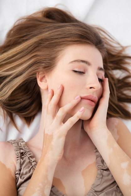 Mooie jonge vrouw met vitiligo