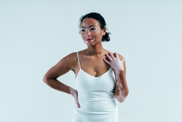 Mooie vrouw met vitiligo huid poseren in studio. concept over lichaamspositiviteit en zelfacceptatie