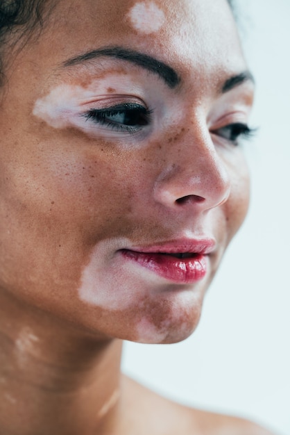 Mooie vrouw met vitiligo huid poseren in studio. Concept over lichaamspositiviteit en zelfacceptatie