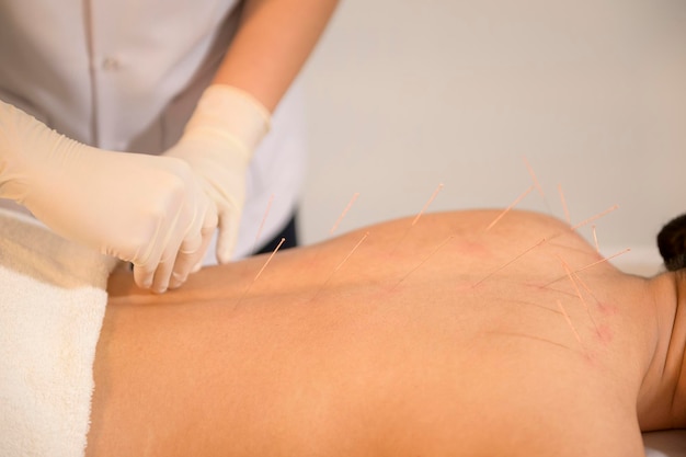 Mooie vrouw Ontvangen acupunctuurbehandeling op rug door therapeut