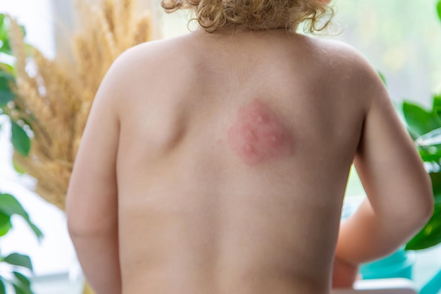 Mosquito bites on a child back Selective focus