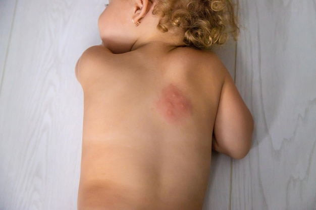 Mosquito bites on a child back Selective focus