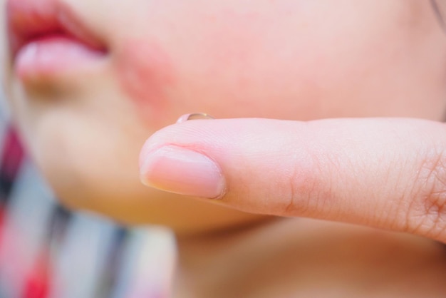 蚊に刺されたために皮膚の発疹と赤い斑点のあるアレルギーのある子供の顔に局所抗ヒスタミンクリームを塗っている母親