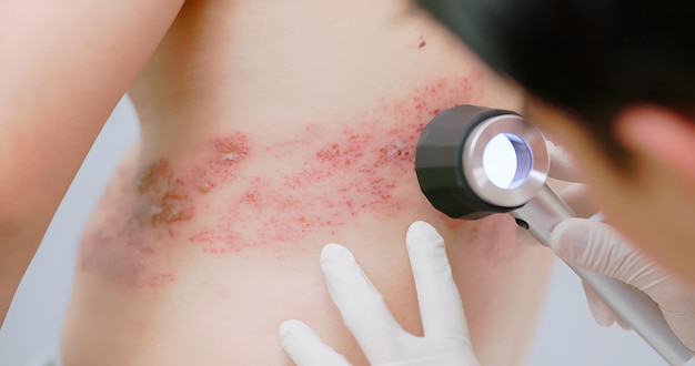 Photo mother putting cream on chickenpox rash