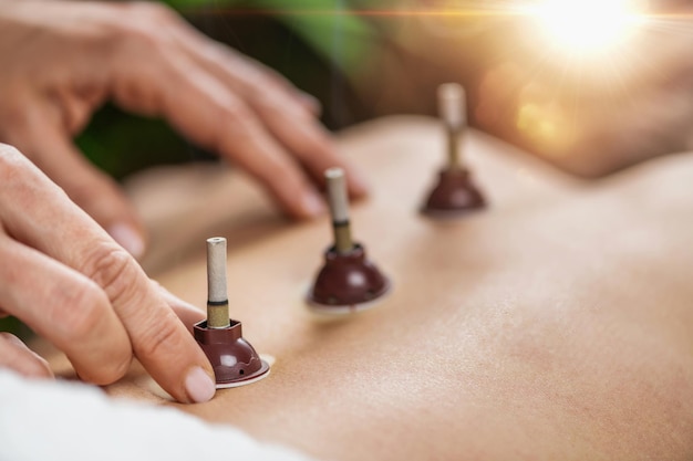 Photo moxibustion traditional chinese medicine treatment hands of a practitioner placing a mugwort