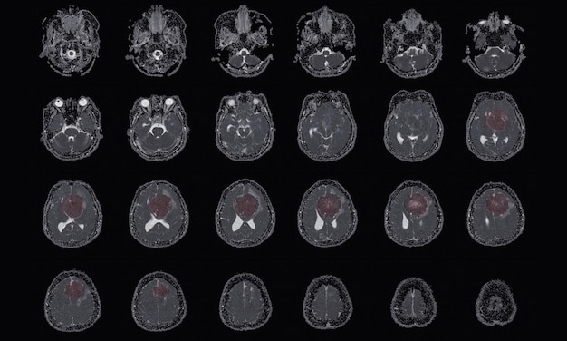 사진 mri brain 왼쪽 전두엽에서 인접한 최소 perilesional 부종과 함께 양측 전두엽으로 확장되는 전두엽 대뇌에서 발생하는 수막종의 발견 의료 이미지 개념