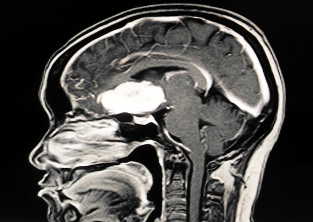 MRIまたはCTスキャン脳Rt.sphenoid ridge meninggioma