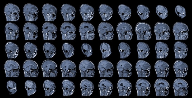 MRI Hersenen Axiale beelden om hersentumor te evalueren Glioblastoom hersenmetastase isodensiteitsmassa met een slecht gedefinieerde marge en omringend oedeem in de rechter frontale kwab