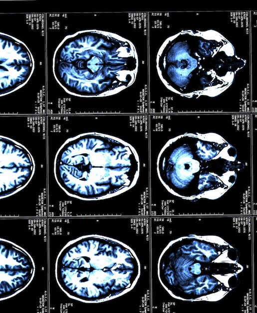 Foto mri-hersenscans van een patiënt met multiple sclerose