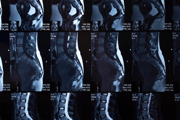 女性の腰仙椎の MRI 画像。 X線。