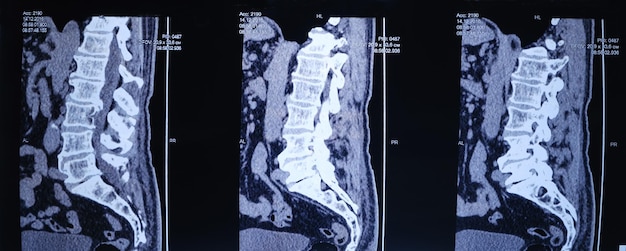 MRI image of the spine of a patient with scoliosis and protrusion of the intervertebral disc