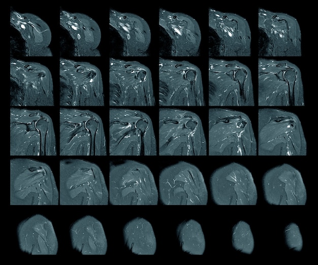 Photo mri left shoulder rotator cuff tear with suspected lipoma of left shoulder science and education