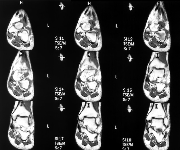 Immagine di risonanza magnetica mri del piede sinistro e della caviglia