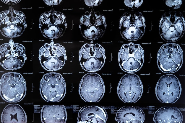 Mri met hersentumor Magnetische resonantiebeeldvorming