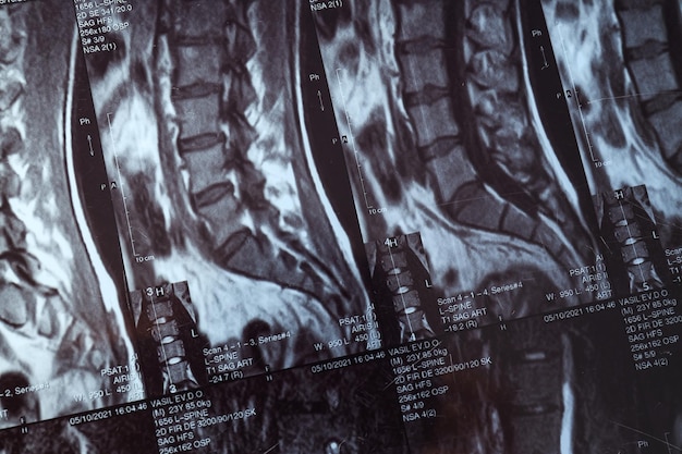 Foto mri of magnetische resonantie beeldvorming van de menselijke wervelkolom closeup